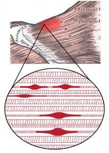 What Relieves Painful Muscle Knots (Trigger Points)?